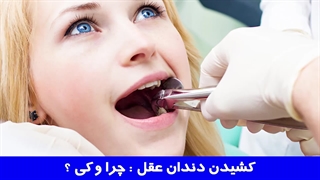 کشیدن دندان عقل