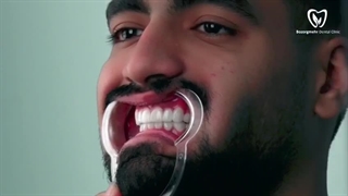 لمینت سرامیکی دندان در مشهد