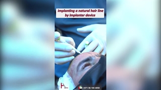 زراعة الشعر بأحدث التقنیات فی عیادة هیلیا