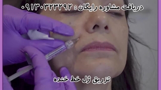 تزریق ژل به خط خنده