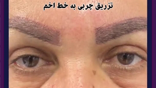 تزریق چربی به خط اخم
