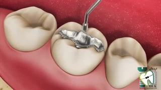 پرکردن دندان با آمالگام (مواد نقره ای)