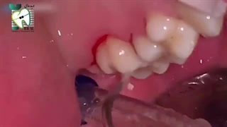 فیلم جراحی جرم گیری دندان