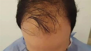 کاشت مو طبیعی