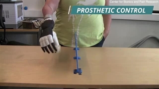 دست مصنوعی بیونیکی که زندگی افراد را دگرگون می کند