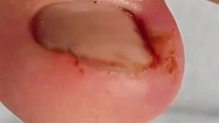 جراحی ناخن پای مردان