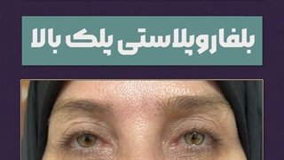 بلفاروپلاستی پلک بالا-5