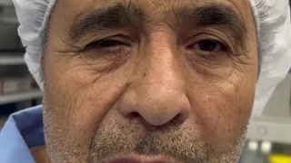 ویدئوی قبل و بعد لیفت ابرو