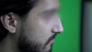 تزریق فیلر بینی مشهد