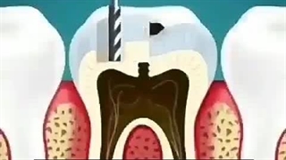 درمان ریشه دندان ( کلینیک دندانپزشکی شبانه روزی آرتین ) کرج