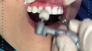 8 واحد ونیر کامپوزیت دندان ( کلینیک دندانپزشکی شبانه روزی آرتین )