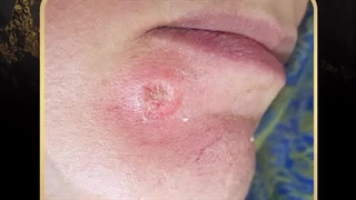 برداشتن خال و زگیل در ارومیه