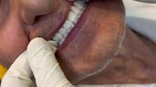 فیلم دندان مصنوعی ثابت / ژله ای / متحرک