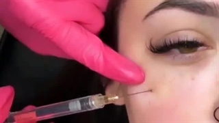 اگه سیاهی زیر چشم داری! فیلر زیرچشم نزن!