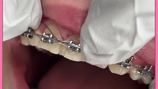 ارتودنسی بلیچینگ دندان