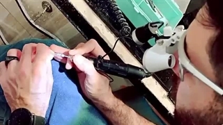 فیلم گذاشتن دندان مصنوعی با پایه ایمپلنت