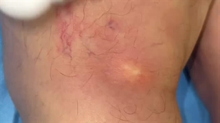 درمان واریس در کلینیک قلب و عروق دکتربرادران