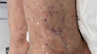 تاثیر درمان واریس بر زیبایی پوست !