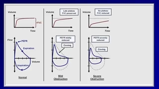 Pulmonary Function Tests (PFT): Lesson 5 - Summary and Practice Cases
