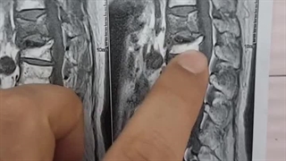 جراحی کایفوپلاستی