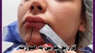 تزریق چربی به صورت لیفت گردنایمپلنت دندان