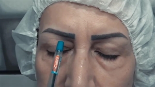 فیلم قبل و بعد عمل جراحی بلفاروپلاستی