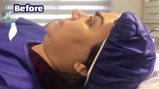 فیلم قبل و بعد ساکشن غبغب و زاویه سازی فک