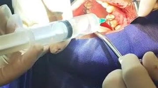 ایمپلنت کار حرفه ای-3