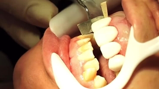 پولیش کامپوزیت دندان در مشهد