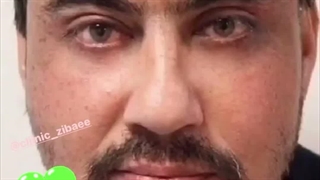 لیفت صورت در کلینیک آرتین