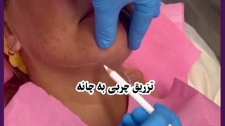 تزریق چربی به چانه
