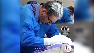 زراعة الشعر فی عیادة هیلیا: کم تستغرق المدة؟