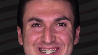 جراحی همزمان فک و چانه