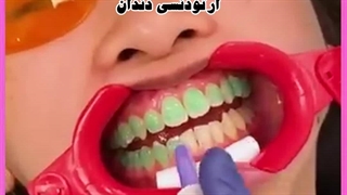 ارتودنسی کاشت ابرو