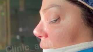 جراحی بینی نیمه فانتزی در کلینیک آرتین
