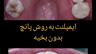 ایمپلنت بدون بخیه