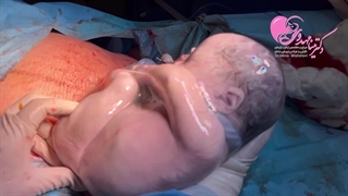 سزارین دو قلویی (دومی)