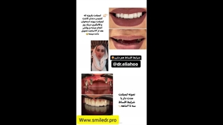 ایمپلنت یک روزه صاحب دندان شوید