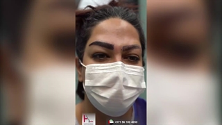 زراعة الحواجب طریقة للحصول على حواجب کثیفة ذات شکل طبیعی