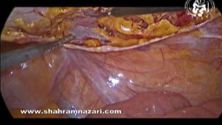 فتق پانتالون (کیسه زینی یا پاچه شلواری) کشاله ران