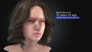 Rhinoplasty (Nose Job)