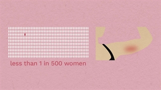 ایمپلنت و بارداری