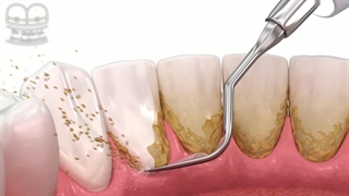 جرم گیری بعد از ارتودنسی