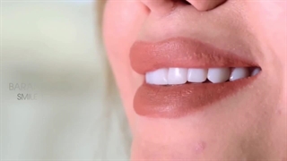 لبخندهای بعد از کامپوزیت مشهد در کلینیک بارانا