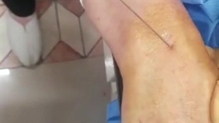 تزریق چربی دست در کرج برداشتن خال