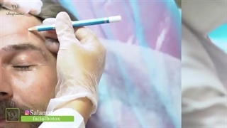 بهترین کلینیک تزریق بوتاکس مشهد