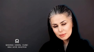 بلیچینگ در مشهد- کلینیک دندانپزشکی بارانا