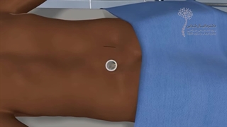 جراحی فیوژن ستون فقرات