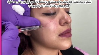 فیلر یا بوتاکس ترمیم ونیر