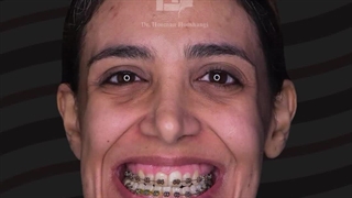 جراحی همزمان دو فک و چانه